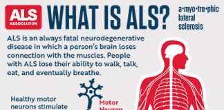 ALS Disease